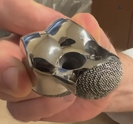 3D Printed ankle replacement