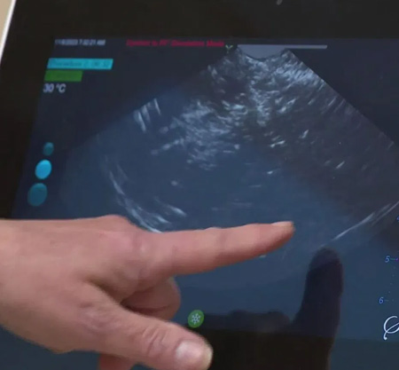 radiofrequency ablation for fibroids