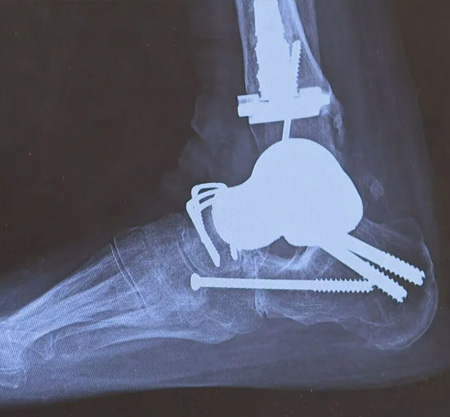 The Christ Hospital Meg Bugenstock Ankle Surgery