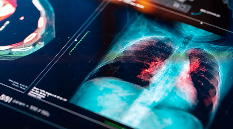 Lung X-ray