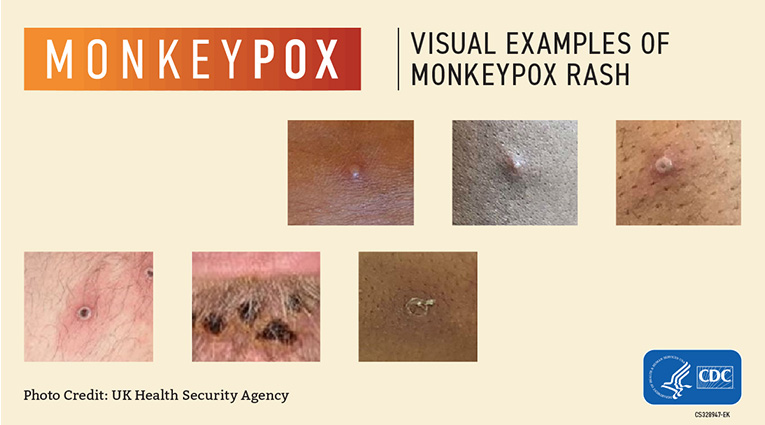 CDC provided image shows skin rash associated with monkeypox