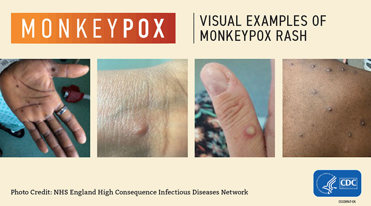 CDC provided image shows skin rash associated with monkeypox