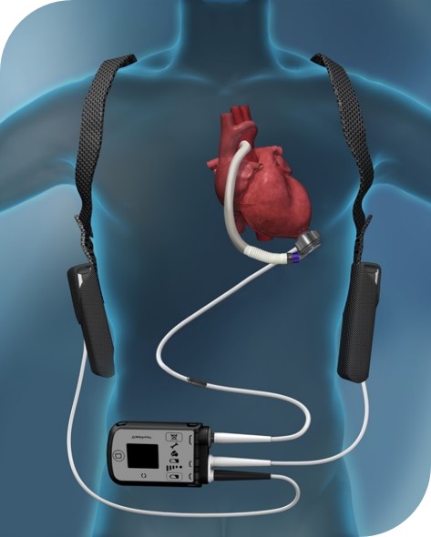 Ventricular assist device