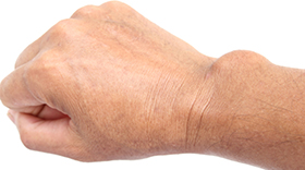 Person with ganglion cyst