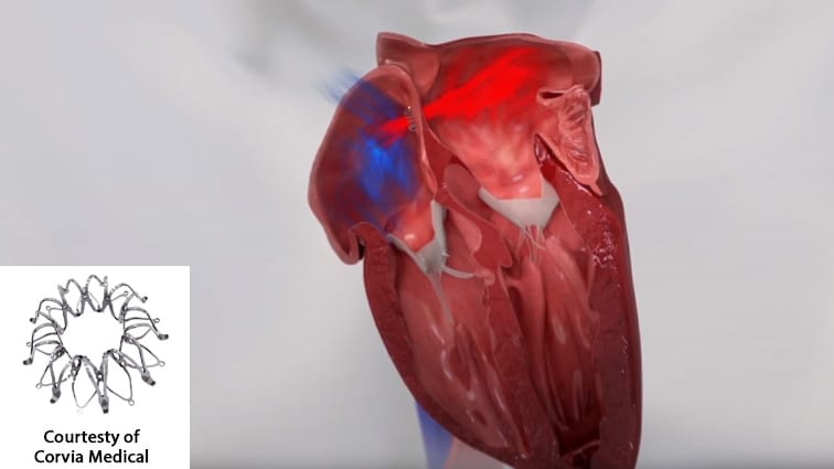 Corvia atrial shunt