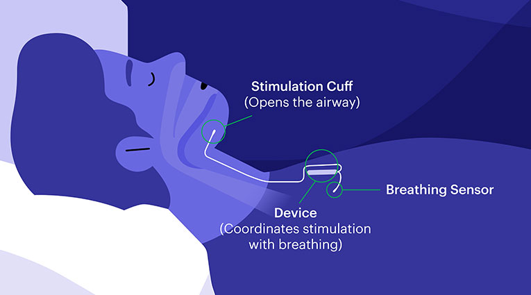 Illustration shows Inspire device connecting to a breathing sensor and stimulation cuff